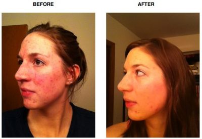 acne tips before and after