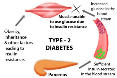 Type 2 Diabetes Cause
