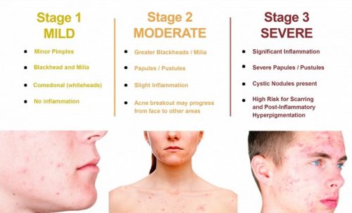 Acne Stages