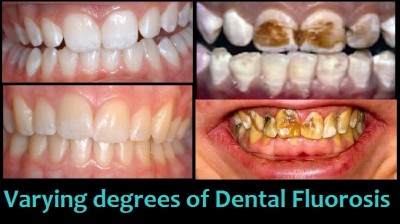 dental fluorisis