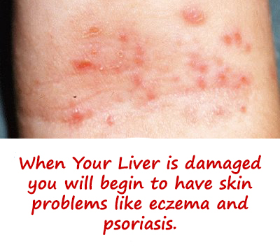 psoriasis liver connection remedies natural eczema