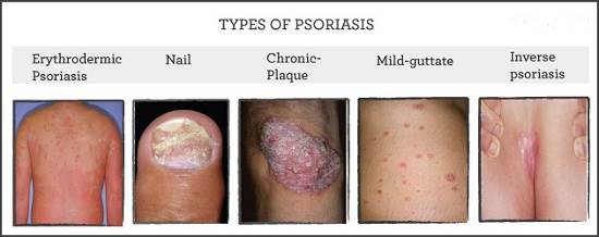 types of psoriasis