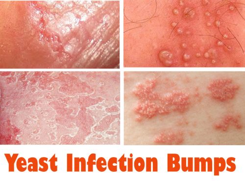 yeast infection bumps