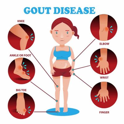 Signs of Gout Disease