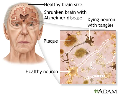 cause of Alzheimer's