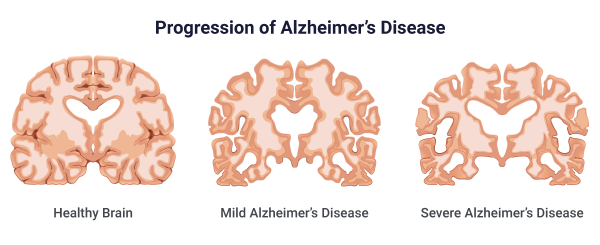 Alzheimer's Progression