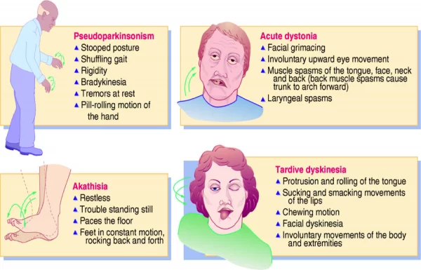 Dystonia vs Tardive Dyskinesia
