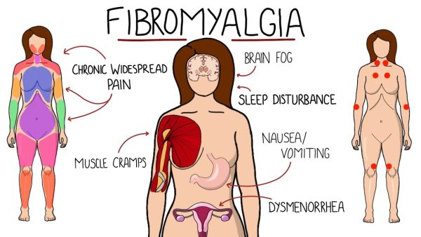fibromyalgia signs and symptoms